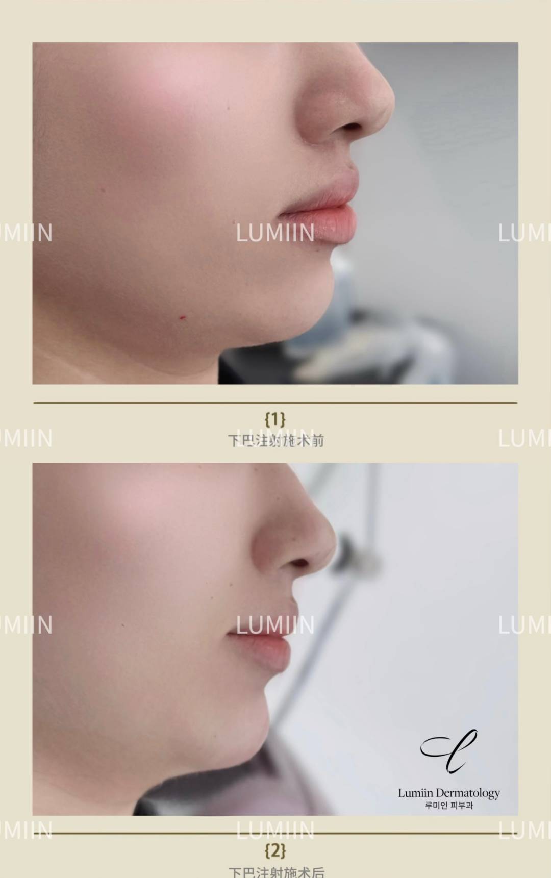 2026 Seoul Gangnam | Ulthera Treatment at Lvmee Dermatology: Three specialist doctors on board + detailed record of the entire treatment process + price list插图4 Ultrasonic Knife - Effect Comparison