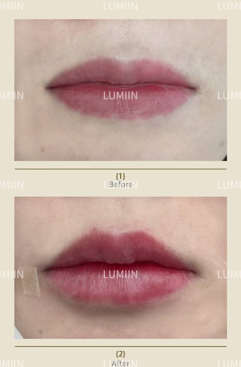 2026 Seoul Gangnam | Ulthera Treatment at Lvmee Dermatology: Three specialist doctors on board + detailed record of the entire treatment process + price list插图5 Ultrasonic Knife - Physician Consultation