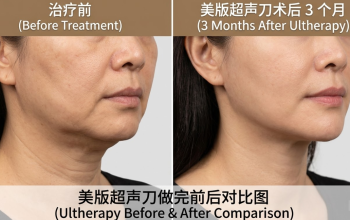 清潭洞美版超聲刀價格2026：美超二代100發2500元起，中韓同價|支持現場掃碼驗真缩略图