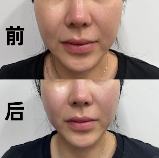 The price for one session of South Korea’s Onda Lifting facial treatment starts at 6,300 yuan. Come and experience it for yourself! Reservation methods are available at 3 certified clinics.