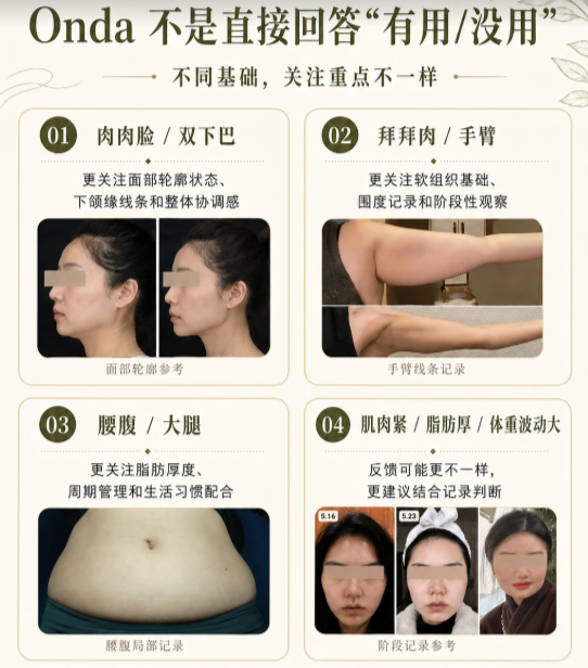 Comparison of Onda Full-Face Lifting Results