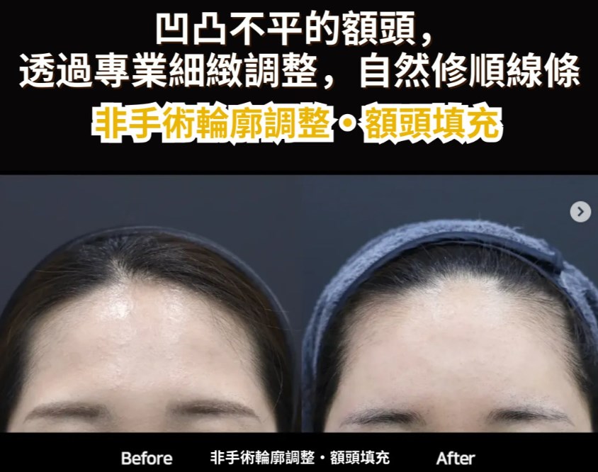 2026韓國玻尿酸填充推薦|goldj/pixelab/美乐等膚科評比,蘋果肌/淚溝/嘴唇全解析插图2 goldj皮膚科玻尿酸填充對比圖