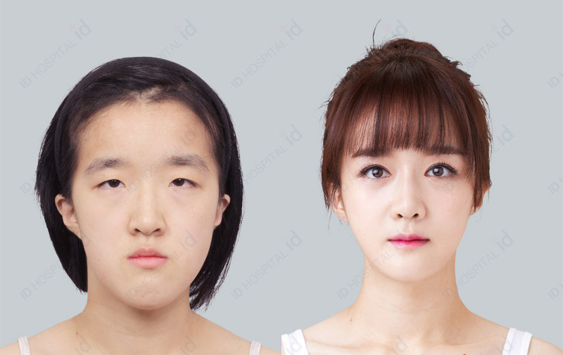 ID整形外科雙顎術前術後對比