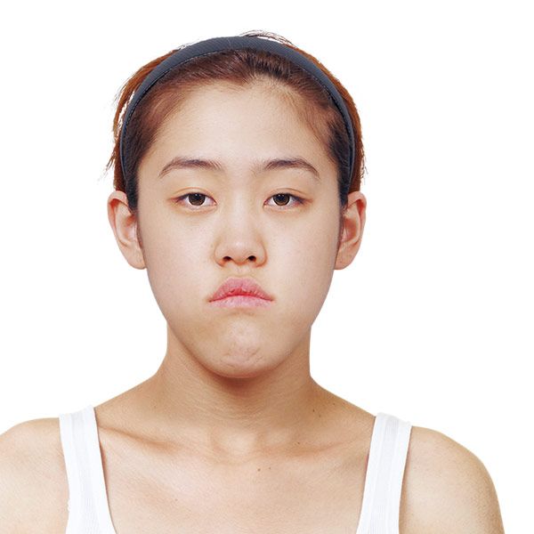 ID整形外科LetMeIn節目案例術前