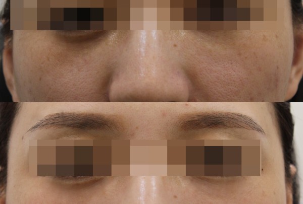 Planew超聲刀+麗珠蘭聯合療程示意圖