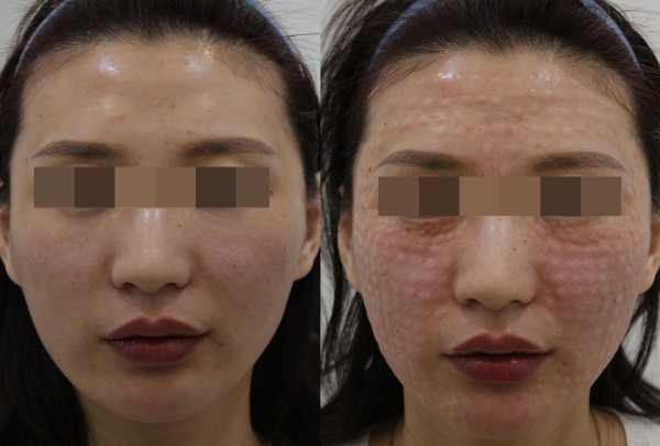 Planew女性患者抗衰療程護理圖