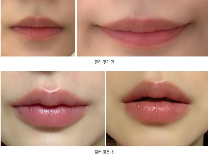 濟州島4ever醫美預約全流程:中文院長在線溝通,下飛機就能打麗珠蘭插图3 濟州島4ever醫美預約全流程:中文院長在線溝通,下飛機就能打麗珠蘭插图3