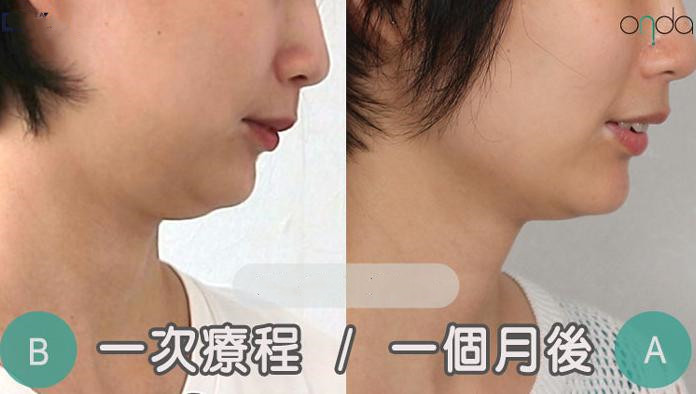 去韓國做 Onda 需怕被坑嗎？2026 年的最新價格表在此，保證您不會花冤枉錢！缩略图