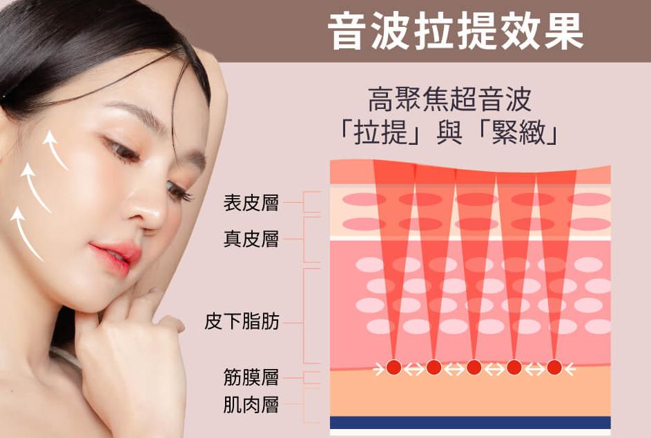 韓國音波拉提哪家醫院好?明洞丹雅、鹿美人、Barog、JD真實評價整理插图 韓音波拉提作用