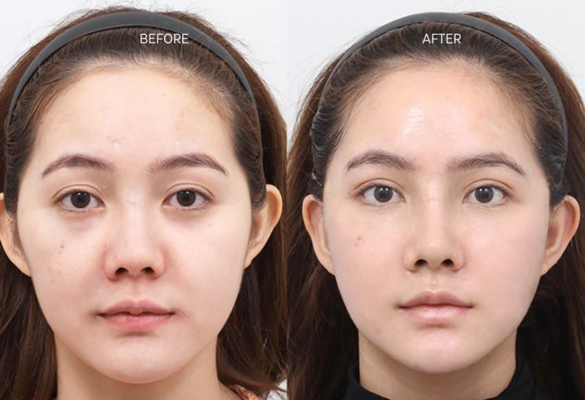 2026韓國熱瑪吉皮膚科推薦|美lab、ELEV、JD等10家熱門皮膚科完整評比,價格優勢一次看插图4 熱瑪吉治療前後對比圖