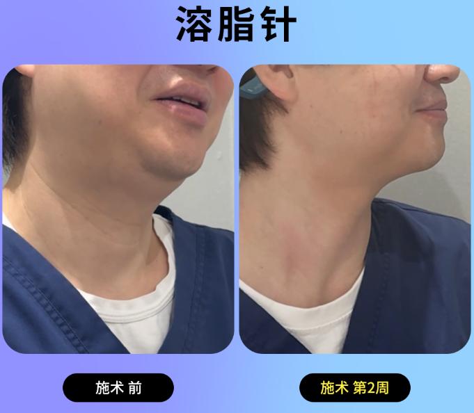 韓國脂肪溶解針對雙下巴的效果對比