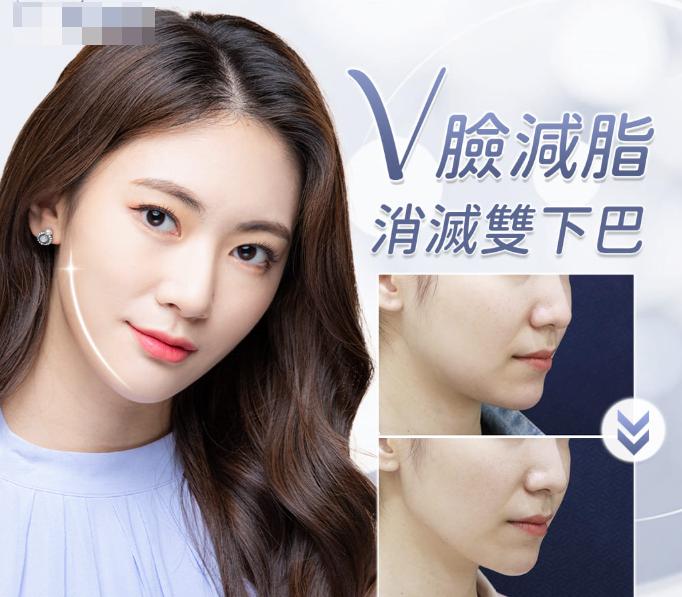 2026年韓國的脂肪溶解針費用是多少？首爾實際測試結果：面部治療的費用最低為3萬韓元，雙下巴治療的費用則最低為1.9萬韓元。缩略图