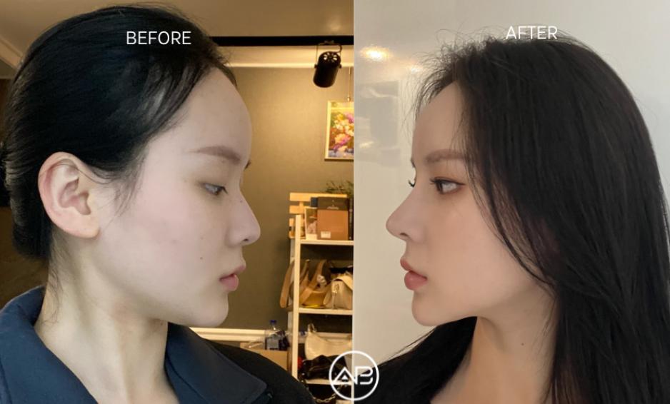 韓國埋線提拉多少錢2026?首爾線雕推薦+V臉效果真實體驗分享插图5 首爾埋線提拉真實案例