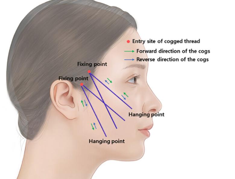 韓國埋線提拉多少錢2026?首爾線雕推薦+V臉效果真實體驗分享插图1 埋線提拉是什麼示意圖