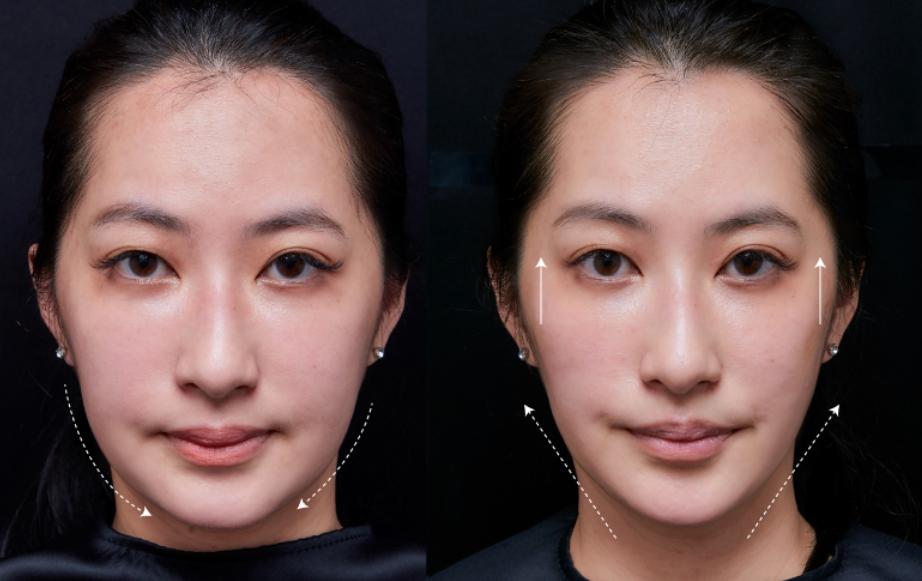 鼻子山根注射對比圖