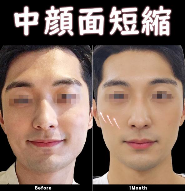 韓國VMJ皮膚科價格表全攻略｜江南線雕・熱瑪吉・玻尿酸費用透明公開缩略图