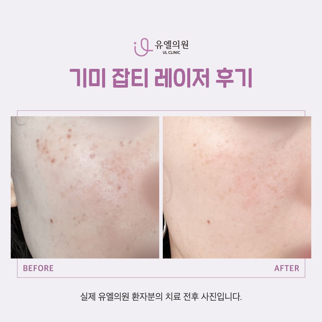 Pengenalan Program Penghilangan Noda dengan Laser di Klinik Kulit Korea