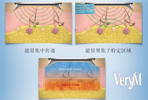 韓國首爾皮膚科諮詢室，醫師說明ONDA療程方案與價格