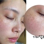 Saya telah berkonsultasi dengan tiga klinik kulit terkenal di Seoul, dan akhirnya memilih Forena, karena dokter mengatakan bahwa alat ultrasonik tersebut tidak cocok untuk semua orang.缩略图