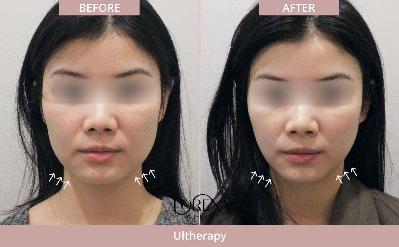 ผลลัพธ์จากการรักษาด้วยเครื่อง Ultherapy
