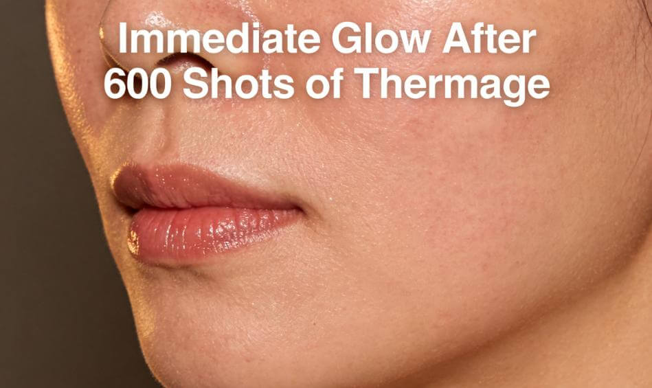 My First Thermage Experience in Korea