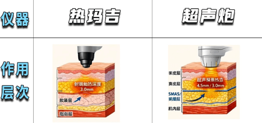 Ultherapy vs Thermage