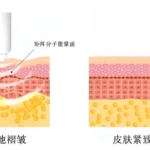 Ultherapy vs Thermage