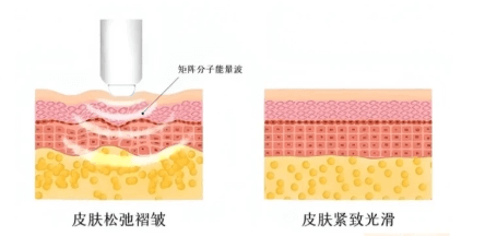 Ultherapy vs Thermage