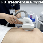 HIFU treatment cost