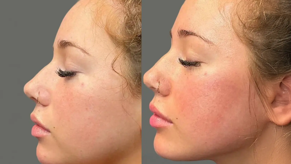 What to Expect During the Treatment