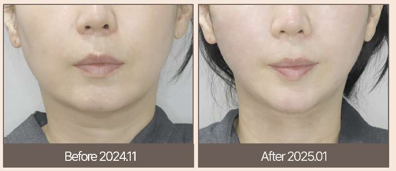 韓國皮膚科外國人價格陷阱