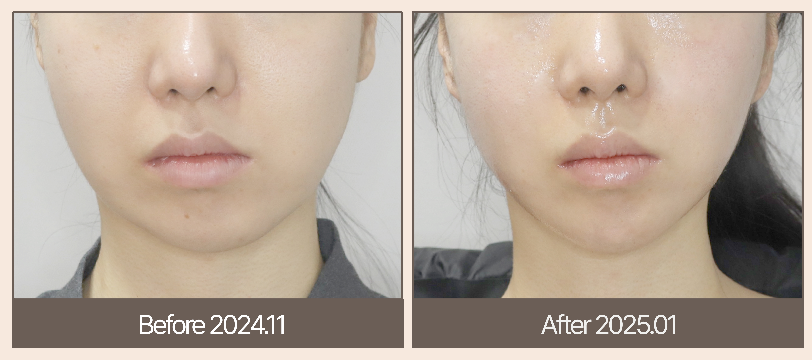 很多人對韓國醫美的印象，總停留在「貴族消費」或「低價遊戲」兩極。但真相往往介於兩者之間。