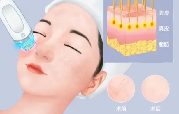 在濟州島4ever皮膚科做黃金微針是種什麼體驗?價格透明、醫生一對一,濟州島醫美首選插图2 濟州島4ever皮膚科價格透明