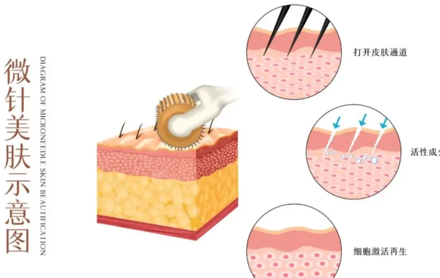 在濟州島4ever皮膚科做黃金微針是種什麼體驗?價格透明、醫生一對一,濟州島醫美首選插图4 黃金微針對比傳統護膚的實際效果