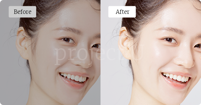 입술 주사 시술 전후 비교