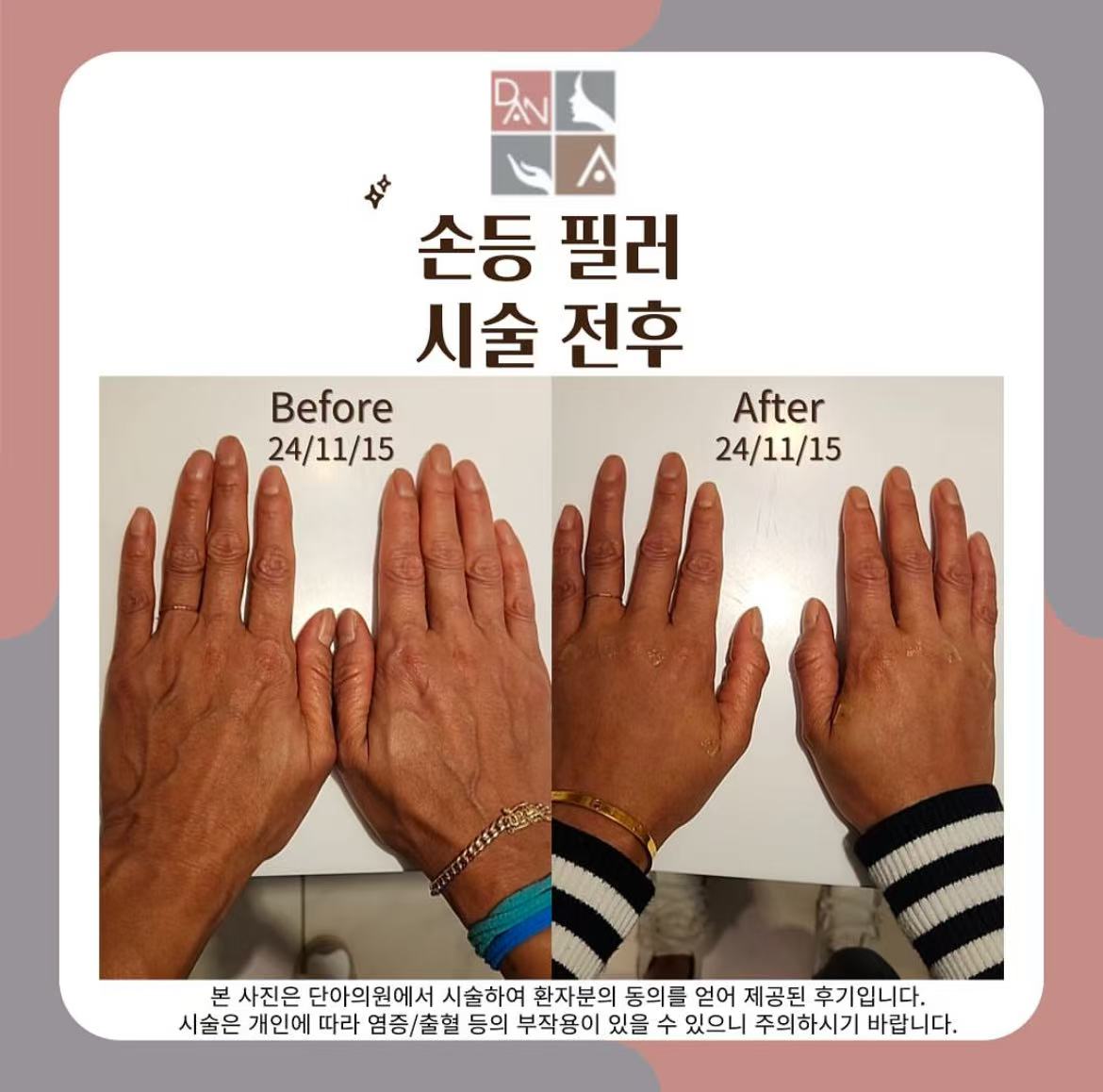 2025 首爾明洞丹雅皮膚科(단아의원)深度評測|14年老牌院長親診、超聲刀認證導師坐鎮插图7 丹雅皮膚科真實用家評價(BeautsGO)