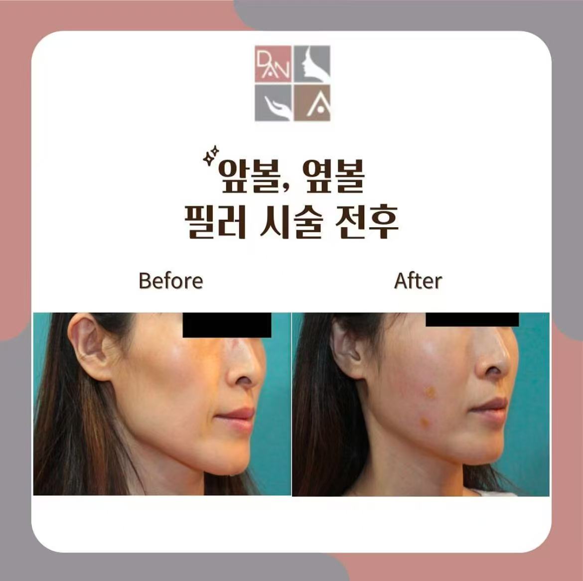 2025 首爾明洞丹雅皮膚科(단아의원)深度評測|14年老牌院長親診、超聲刀認證導師坐鎮插图8 丹雅皮膚科真實用家口碑(BeautsGO)