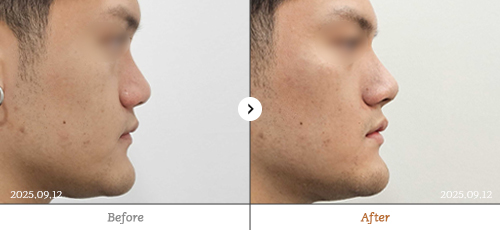 Reberry麗貝瑞皮膚科治療前後對比