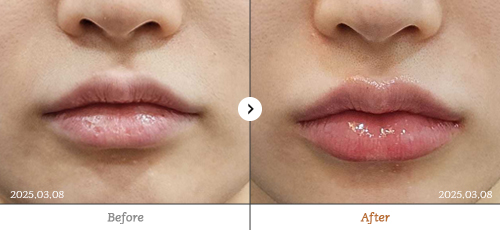 Reberry麗貝瑞皮膚科舒麗可激光治療前後對比