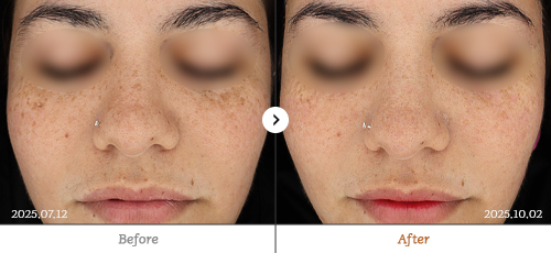 Reberry麗貝瑞皮膚科鈦提升治療前後對比