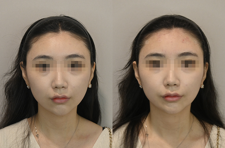Shinebom填充治療前後對比