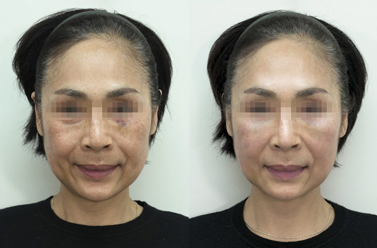 Shinebom抗衰提升治療前後效果