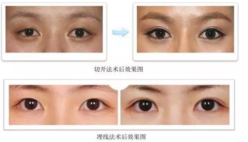 成鎮模醫師個人資料及簡歷：坐診清潭第一整形醫院，30 多年專攻雙眼皮及高難度修復插图3