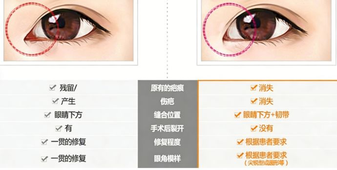 韓國EVE鄭潤載眼修復怎麼樣？技術評測、費用與真實案例深度解析