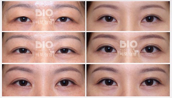 【亞洲眼王】曹仁昌雙眼皮修復案例深度解析:40年傳奇修復技術完整公開缩略图 【亞洲眼王】曹仁昌雙眼皮修復案例深度解析:40年傳奇修復技術完整公開