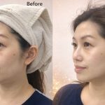 美版超聲刀二代疊加Onda全臉多久有效果？2026年最完整療程效果時間線解析缩略图