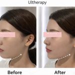 美版超聲刀1–15天變化全紀錄｜逐日恢復圖解＋韓國皮膚科術後護理完整攻略