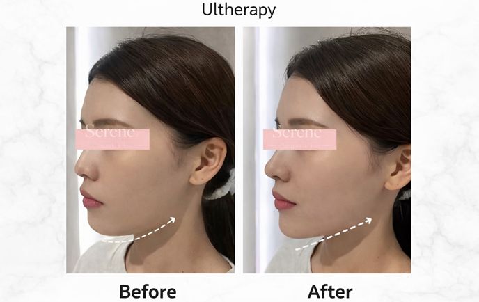 美版超聲刀1–15天變化全紀錄|逐日恢復圖解+韓國皮膚科術後護理完整攻略缩略图 美版超聲刀1–15天變化全紀錄|逐日恢復圖解+韓國皮膚科術後護理完整攻略