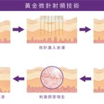 韓國黃金微針價格表多少錢？2026最新費用整理，去之前必看這篇