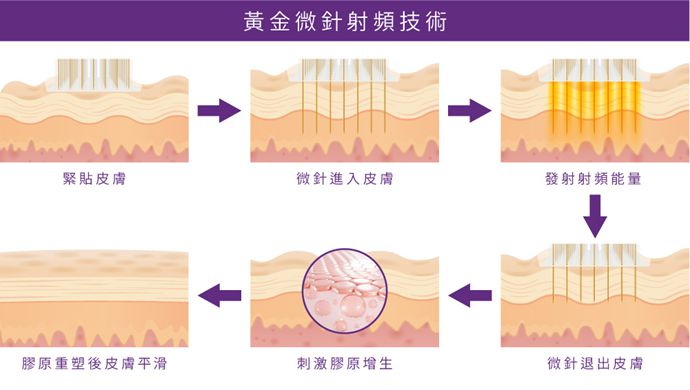 韓國黃金微針價格表多少錢？2026最新費用整理，去之前必看這篇